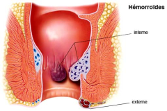 Hémorroïdes