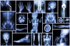 Les problèmes de jambe chez l'enfant sportif