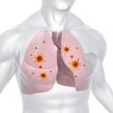 infections dans les poumons