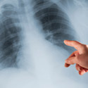 radiographie des poumons