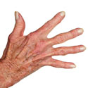 arthrose de la main