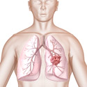 schéma du cancer du poumon