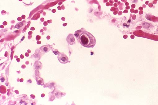 Infection à cytomégalovirus (CMV)